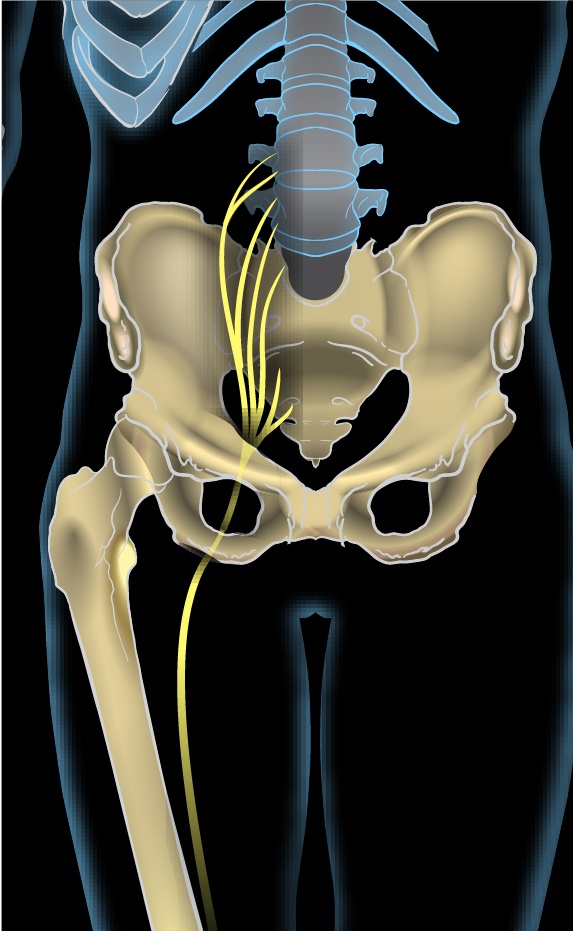 Chiropractor for Sciatica NYC. An illustration of the Sciatic Nerve from Wikipedia. Sciatica (also known as Lumbar radiculopathy) is a phenomena of nerve pain in the spine. Sciatic nerve pain treatment NYC